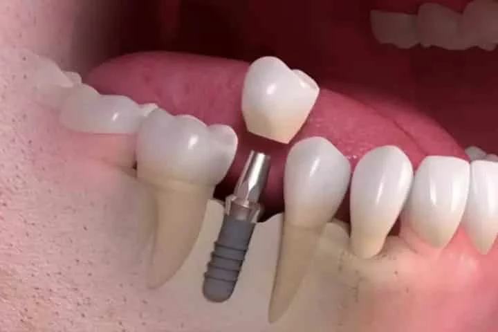 implante dentário