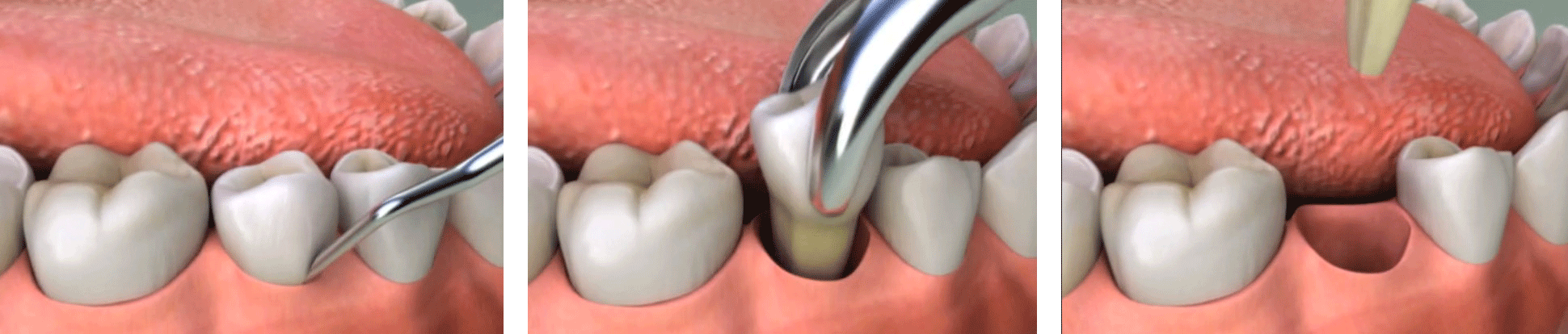 Extrações Dentárias